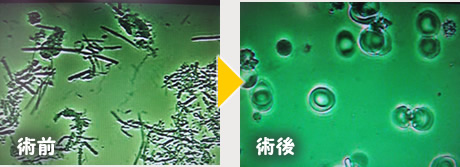 パーフェクトぺリオ術前術後